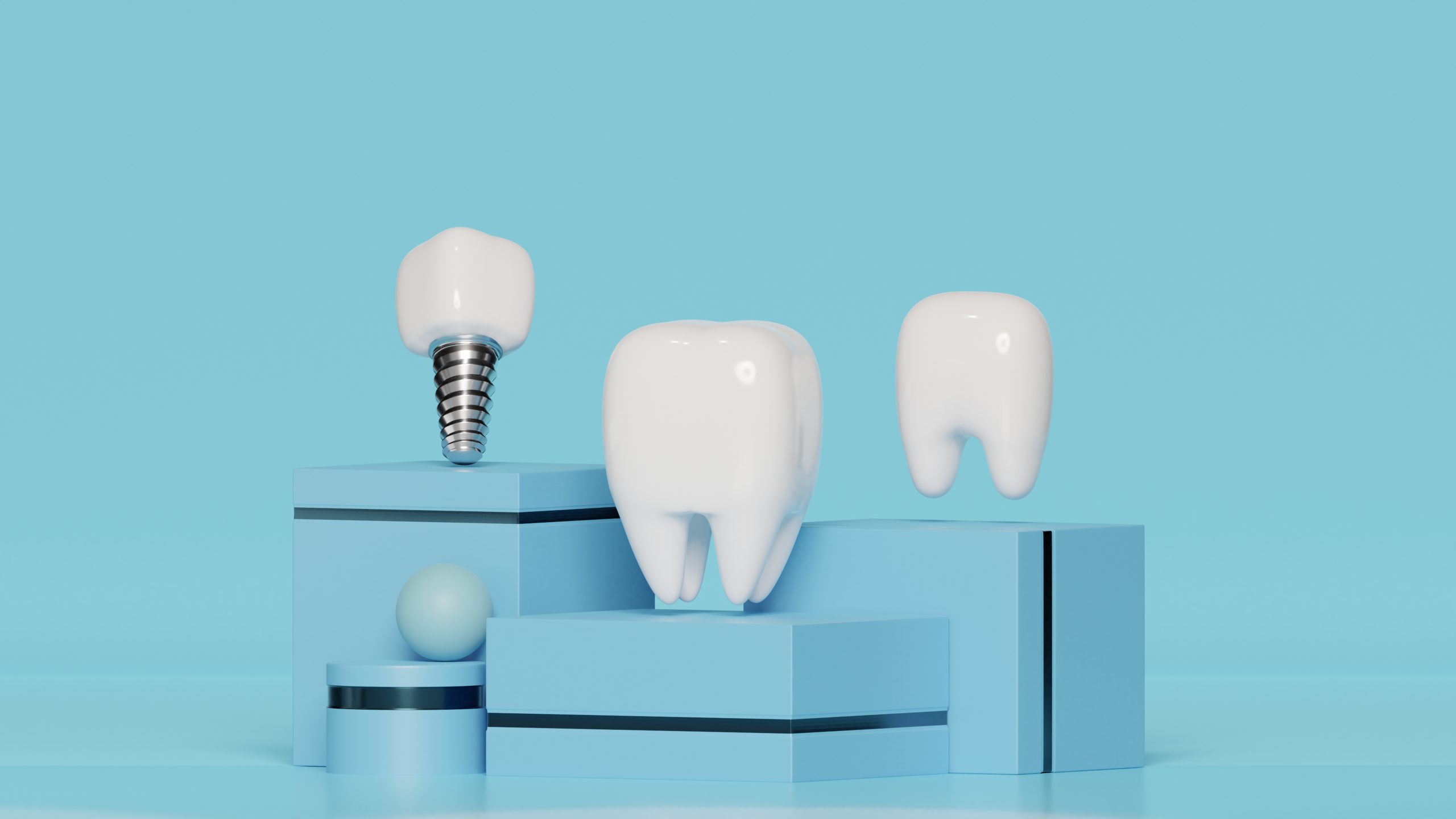 Représentation 3D implant dentaire cabinet Roux et Favre Lyon 8e