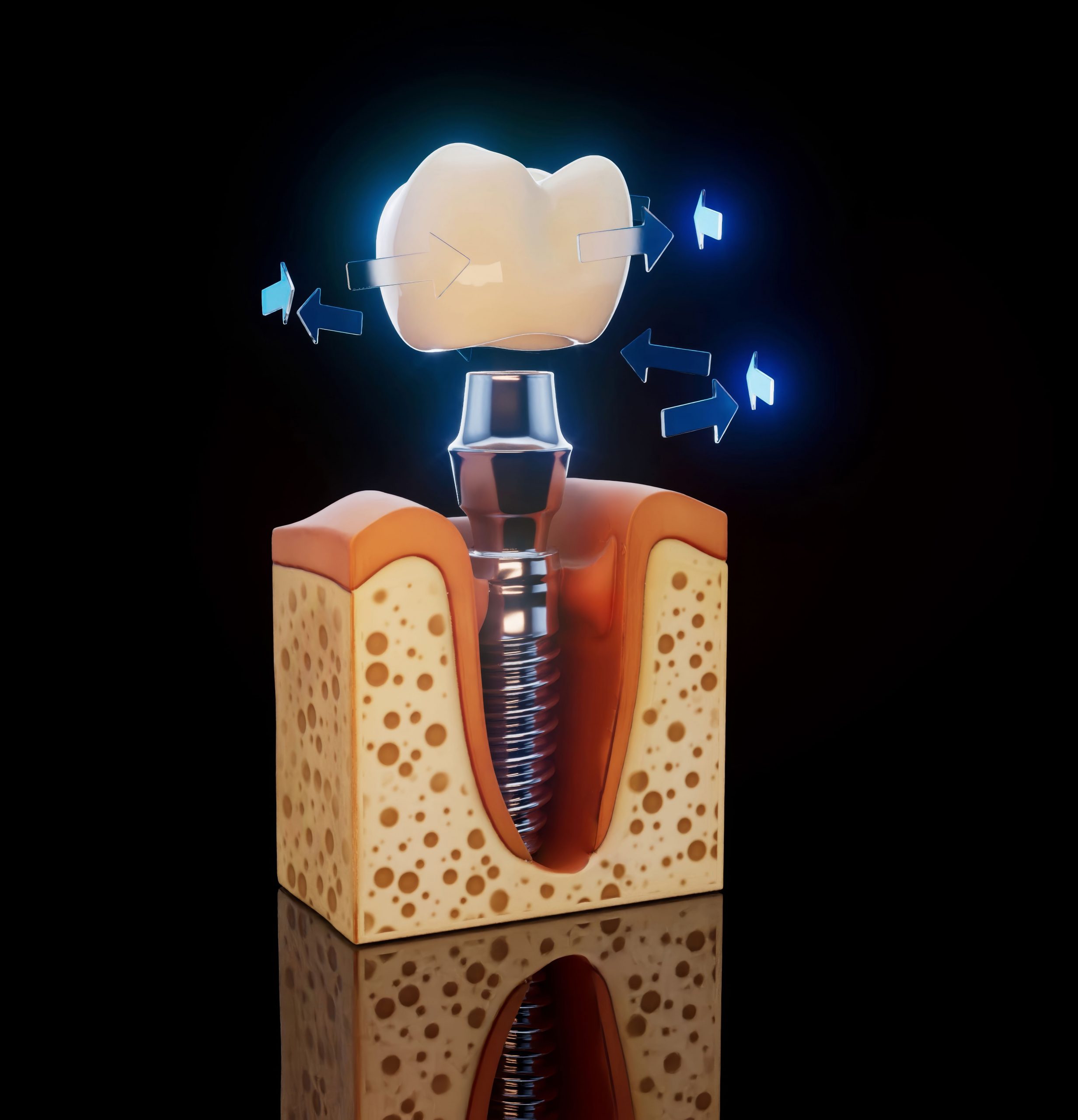 Illustration 3D d'un implant dentaire dans la mâchoire