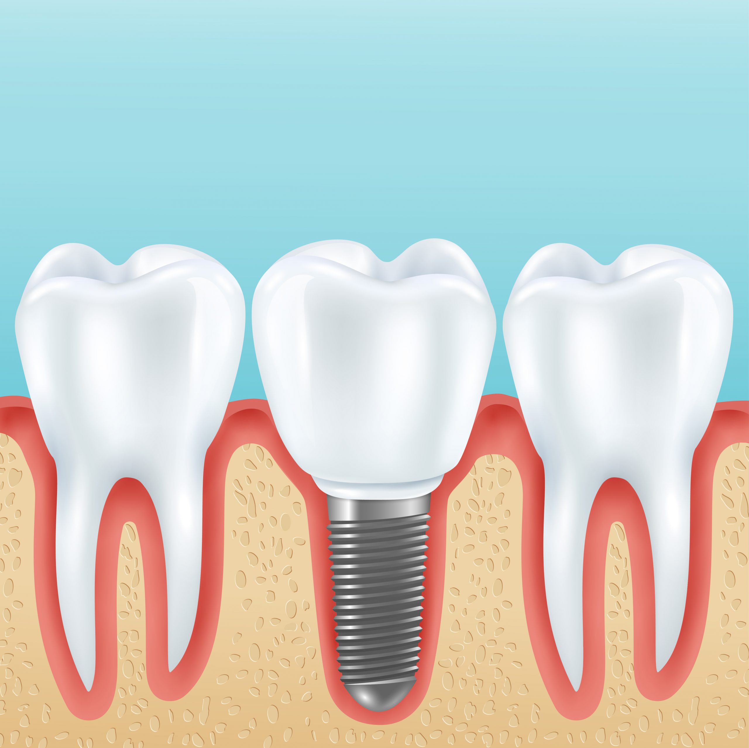 Schéma implant avec couronne prothétique