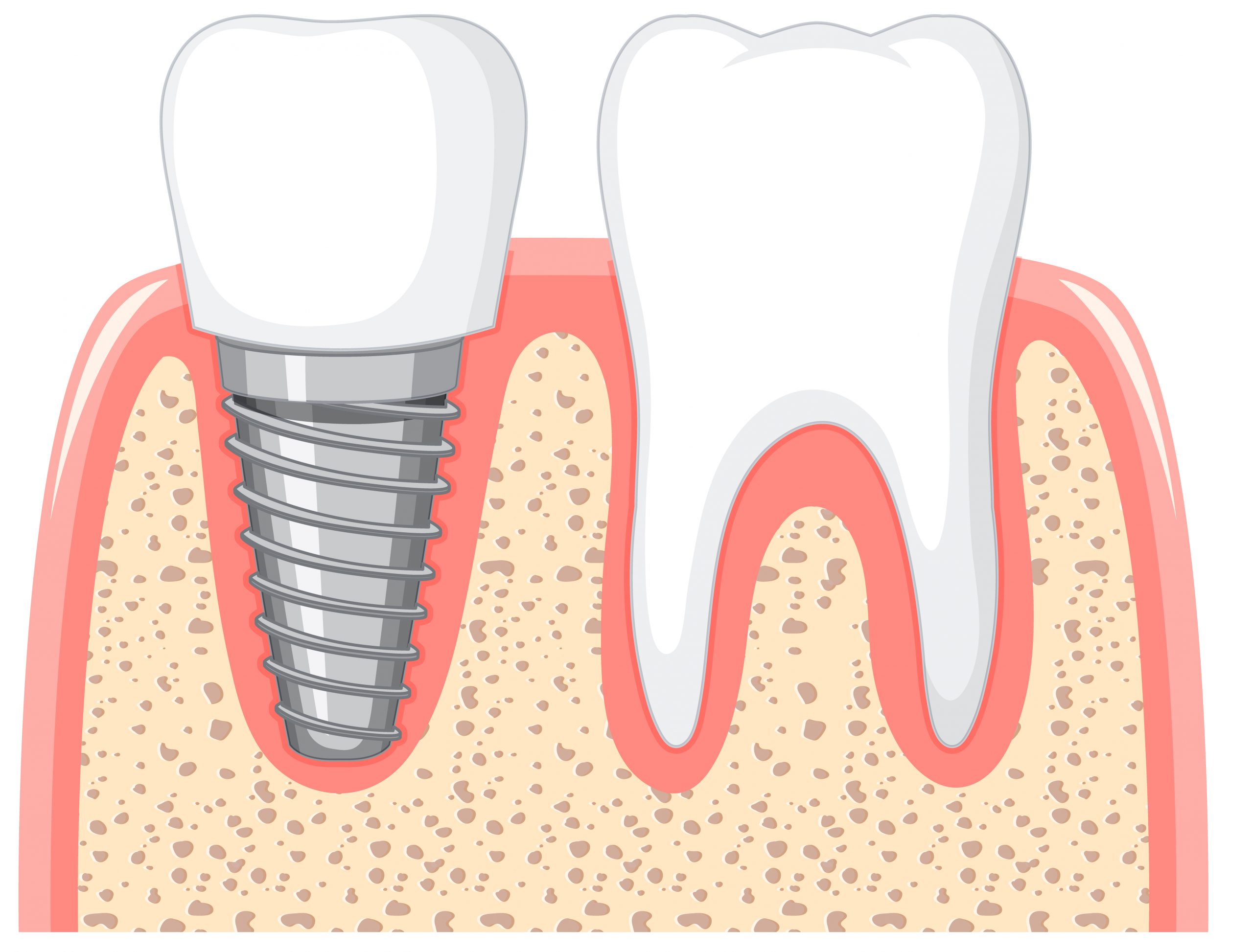 Schéma d'un implant dentaire en coupe